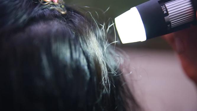 电子显微镜观察头皮健康状况